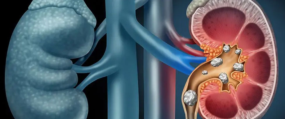 Best Doctor For Kidney Stones in Mulund
