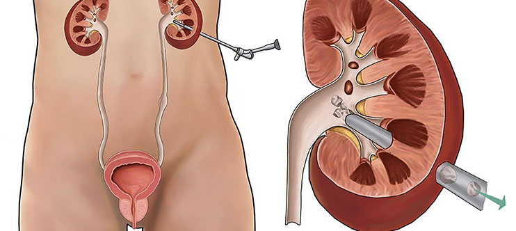 Best PCNL Treatment in Mulund